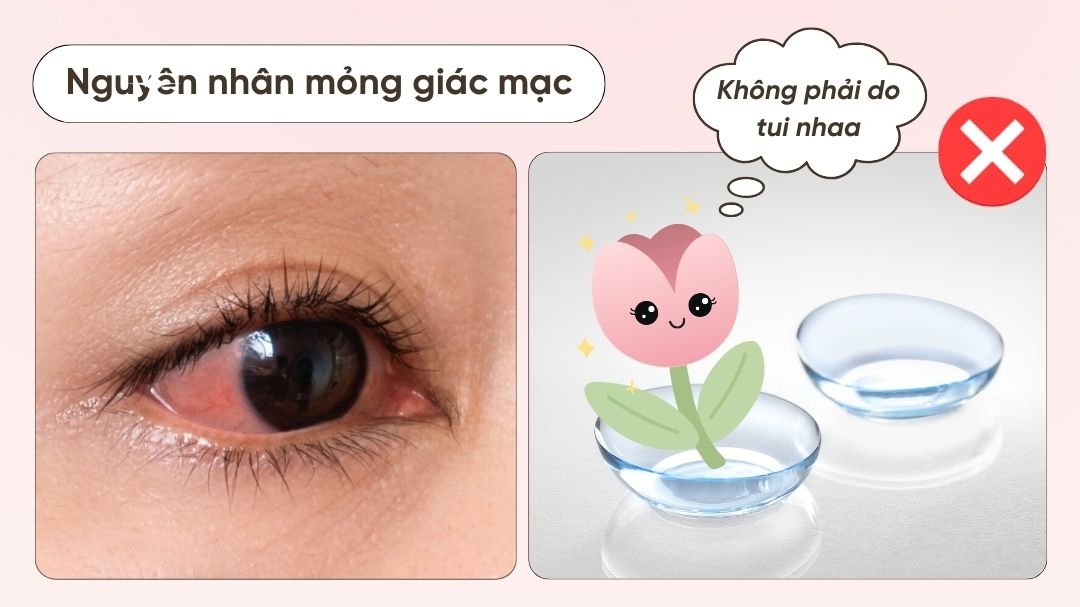 Top 1 nỗi sợ khi đeo lens: Làm mỏng giác mạc!!!