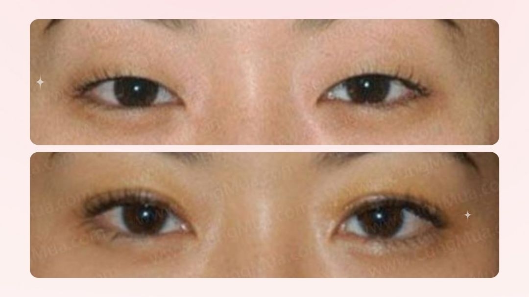 Kính áp tròng - Cứu hộ cho tình trạng mắt dại 