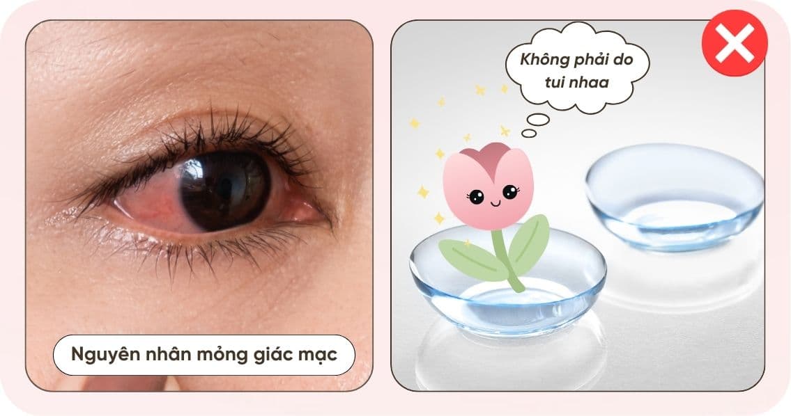 Đeo lens làm mỏng giác mạc (2).jpg