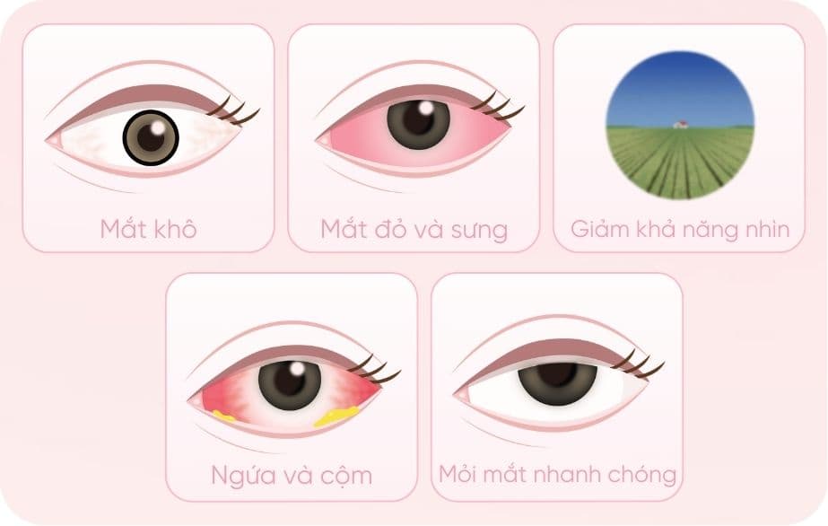 5 dấu hiệu mắt kích ứng khi đeo Lens không nên bỏ qua (2).jpg