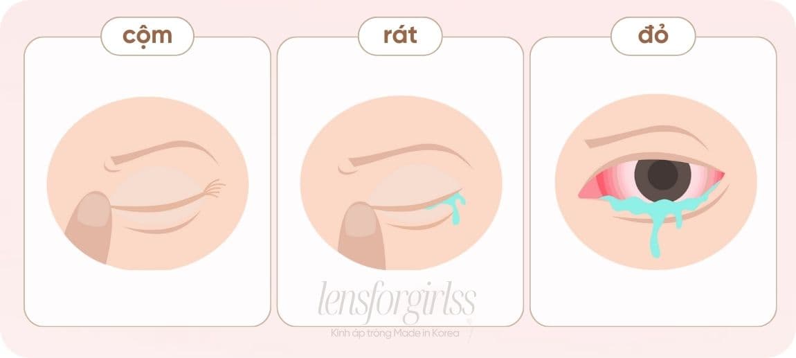 dấu hiệu lens hết hạn (2).jpg