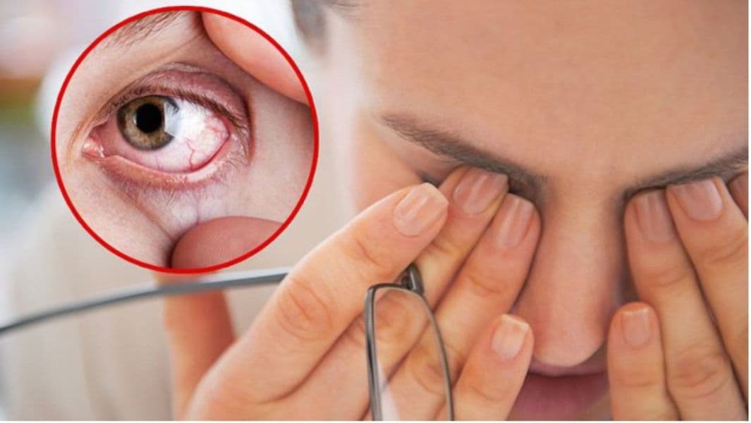 dấu hiệu tạm ngừng đeo lens (2).jpg